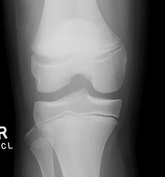 Distal Femoral Fracture SH2 AP